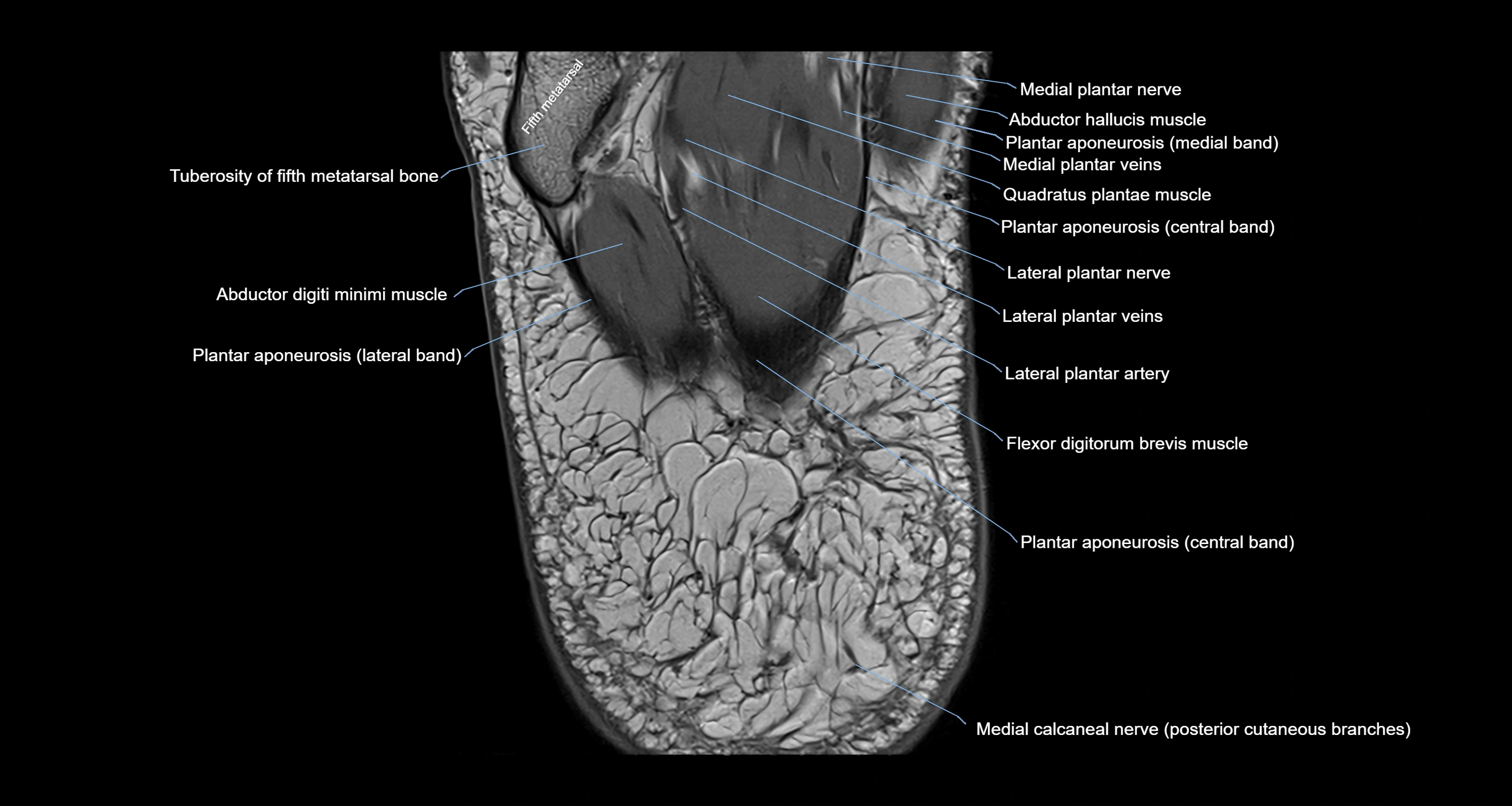 Ankle axial anatomy 3T MRI images -img-10001-00041.webp